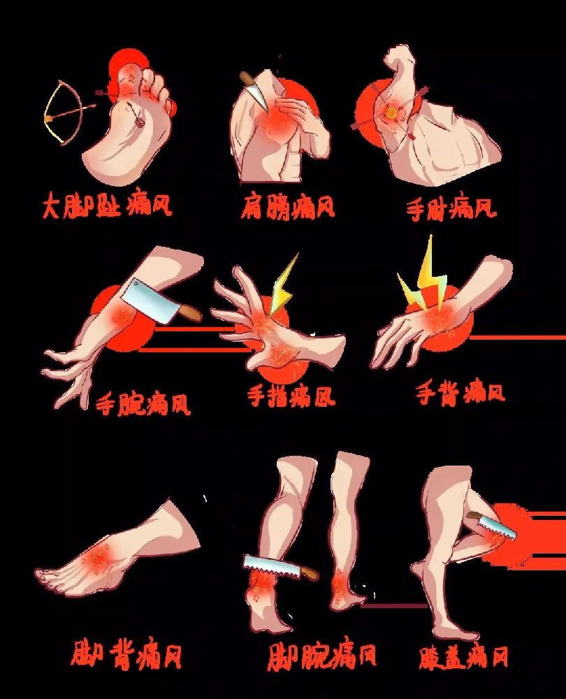 重慶痛風(fēng)急診看什么科